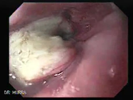 Esophageal Squamous Cell Carcinoma (1 of 5)