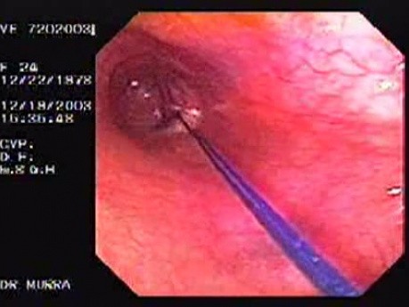 Flexible Endoscopic Suturing - Converting Four Threads into Two