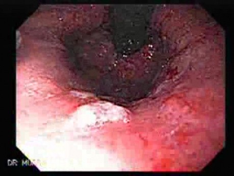 Endoscopic Baloon Dilation Of The Esophageal Stricture - Retroflexed Meneuver