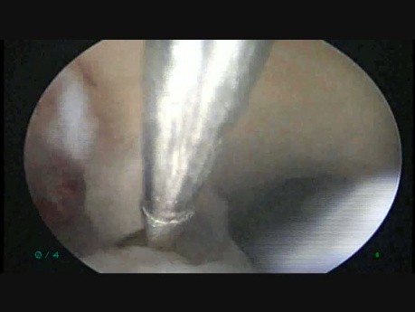 Septum Resection