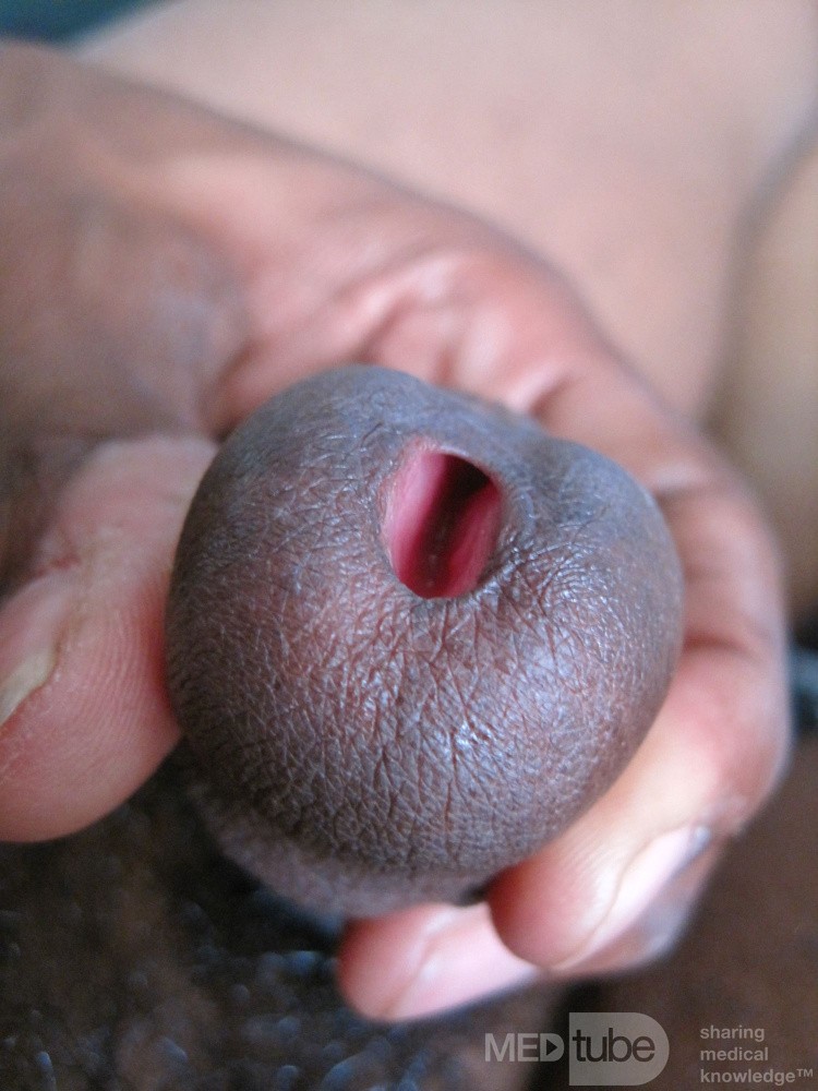 Urethral Meatus