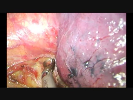 Uniportal Vats Advanced Left Paratracheal, Aortopulmonary, Prevascular Lymphadenectomy (Non Edited)