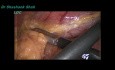 Laparoscopic Sleeve Gastrectomy