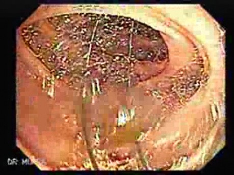 Dental Prothesis Found in the Jejuno (3 of 9)
