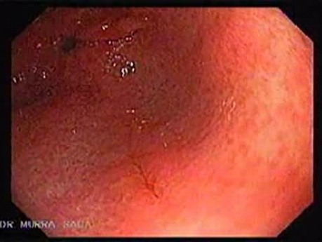 Lineal Erosions of the Antrum (1 of 2)