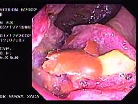 Rectal Adenocarcinoma - 53 Year - Old Man (1 of 2)