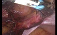 Laparoscopic Hysterectomy for a Hybrid Leiomyoma