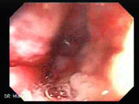 Multiple Adenomatous Polyps Of The Rectum (8 of 37)