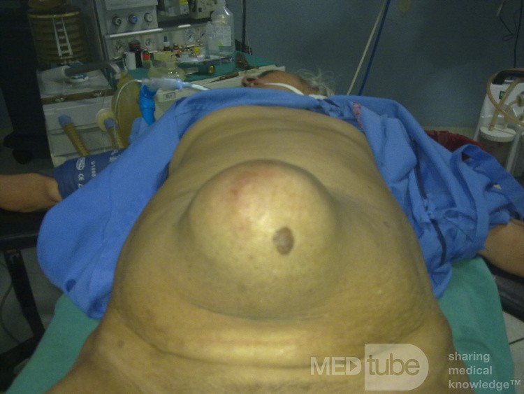 Large Umblical Hernia