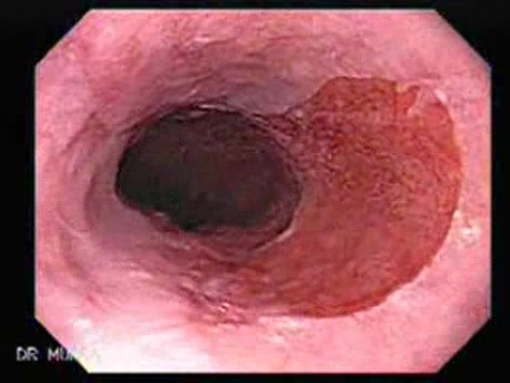 Gastric Heterotopia (inlet pach) (1 of 4)