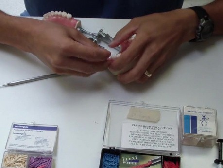 Dental Wedges - A Lame Topic, But It'S Good To Know Your Options