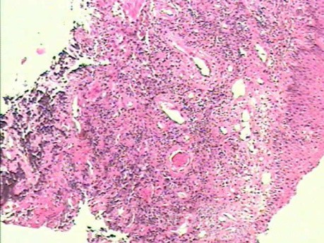 Small cell carcinoma of the lung that invades the upper and
 the middle third of the Esophagus (7 of 7)