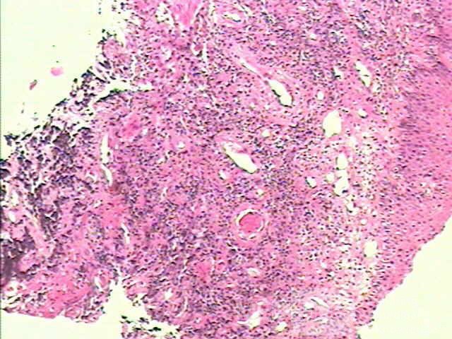 Small cell carcinoma of the lung that invades the upper and
 the middle third of the Esophagus (7 of 7)