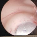 Endoscopic Third Ventriculostomy in a Benign Case of Aicardi Syndrome with Obstructive Hydrocephalus and Chiari Malformation type 1