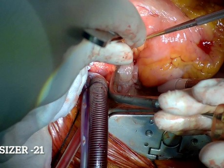 Aortic and Mitral Valve Replacement for Native Valve Infective Endocarditis