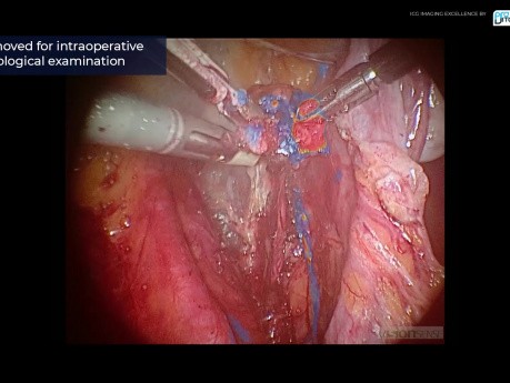 SLNB procedure using ICG imaging in gynecological cancer surgery, review of case series