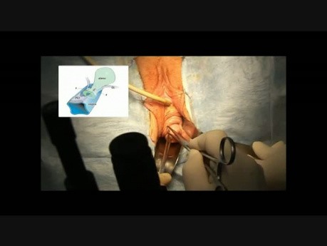 Cardical Ligament / Cervical Ring Defect