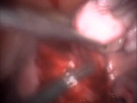 Laparoscopic Myomectomy