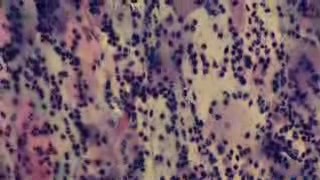 Cervicitis - Lactobacillus acidophilus and leucocytosis
