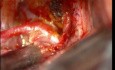 Brain Aneurysm - Anterior Communicating Artery - Microsurgery