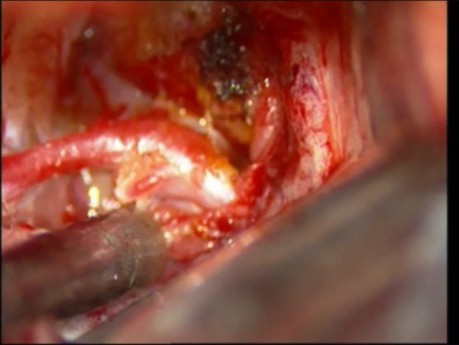 Brain Aneurysm - Anterior Communicating Artery - Microsurgery
