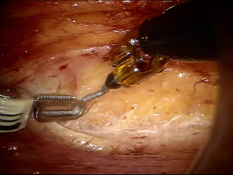 Robotic Inguinal Lymph Node Dissection by Lateral Approach