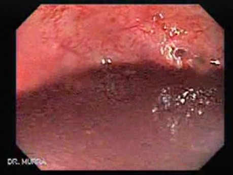 Massive Rectal Bleeding (2 of 11)