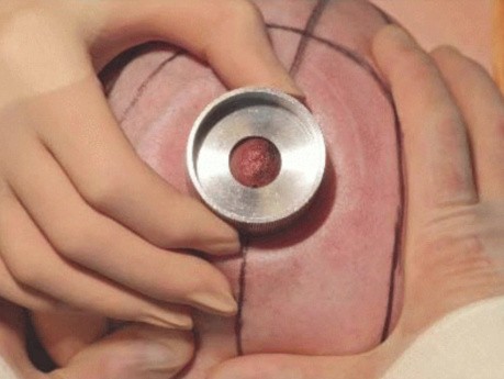 Reduction Mammoplasty