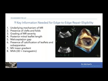 Echocardiographic Evaluation for Mitral Edge-to-Edge Repair