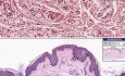 Xanthoma - Histopathology of skin
