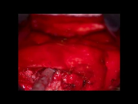 Herniated Disc on the Thoracic Spine
