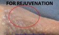 Laser skin rejuvenation  