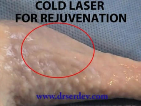 Laser skin rejuvenation  