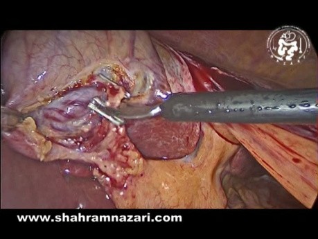 Ectopic Gallbladder Location