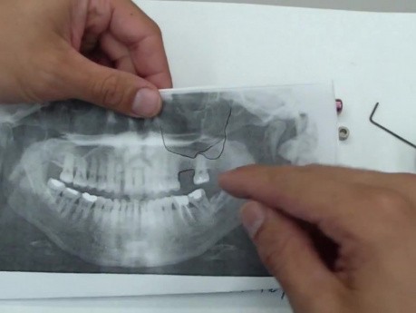 Bone Graft - Sinus Augmentation - Instrumentation