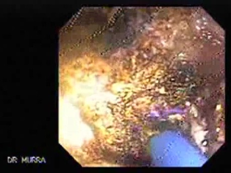 Adenocarcinoma of the Cardia and Carcinoma Epidermoid of the Larynx (9 of 26)