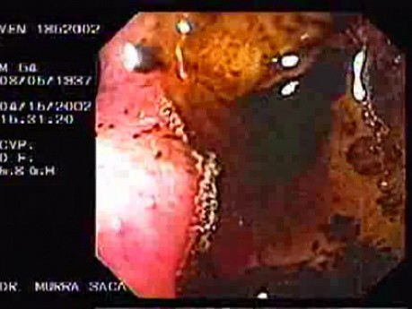 Zollinger- Ellison Syndrome - Gastric Ulcer with Gastrocolic Fistula (5 of 21)