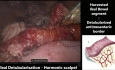 Robotic-Assisted Laparoscopic Ileocystoplasty and Mitrofanoff Appendicovesicostomy