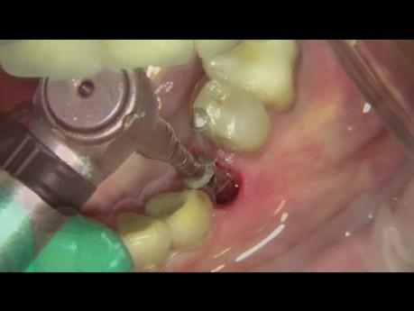 Restoration Digital Work Flow After Immediate Implant