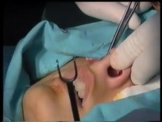 Rhinoplasty - T-excision for Tip Rotarion