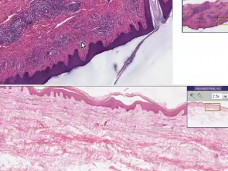 Lymphocytic infiltrate - Histopathology - Skin