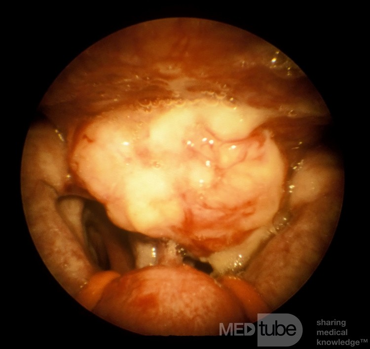 Carcinoma Of The Nasopharynx