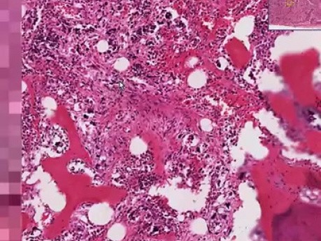 Chronic idiopathic myelofibrosis - Histopathology - Bone Marrow