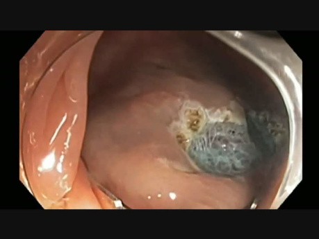Colonoscopy - Transverse Colon Flat Lesion EMR