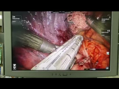 Minimally Invasive Lung Surgery