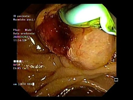 Papillary Adenocarcinoma Diagnosed with EUS and ERCP