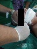 Endoscopic Third Ventriculostomy in a Benign Case of Aicardi Syndrome with Obstructive Hydrocephalus and Chiari Malformation type 1