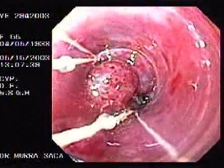 Banding of Esophageal Varices - Ligated Varix
