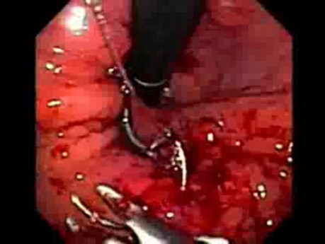 Retrograde Gastroplicature - Suturing - 2/3