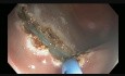 Colonoscopy - Cecum - Flat Lesion EMR
